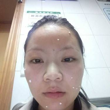 激光点痣