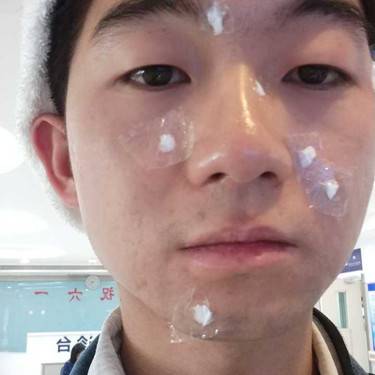 激光点痣