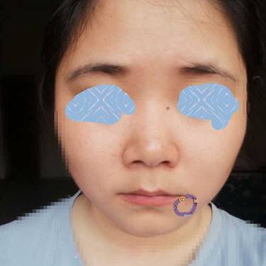 激光点痣