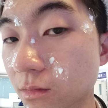 激光点痣