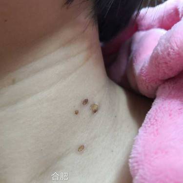 激光点痣