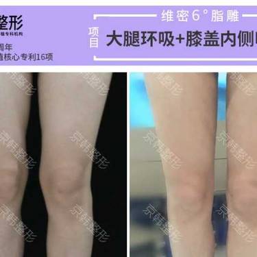 光纤溶脂