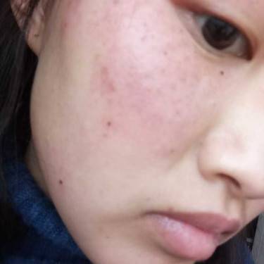 激光淡斑