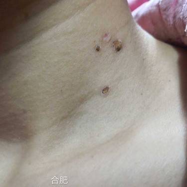 激光点痣
