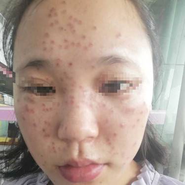 激光淡斑