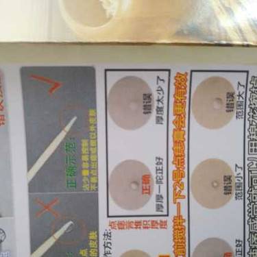 激光点痣