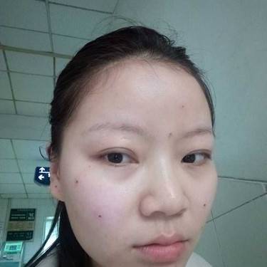 激光点痣