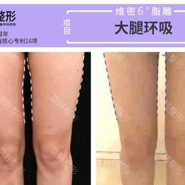 光纤溶脂