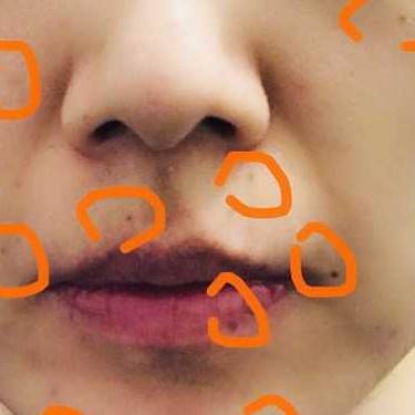 激光点痣