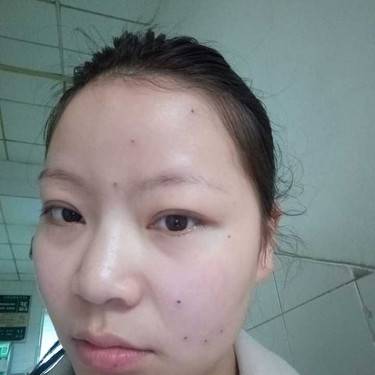 激光点痣