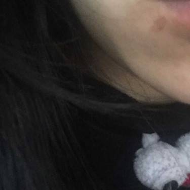 激光点痣