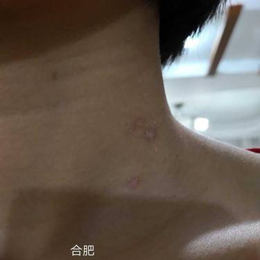 激光点痣