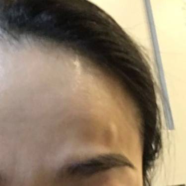 自体脂肪