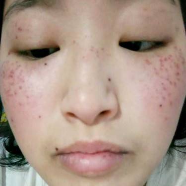 激光淡斑