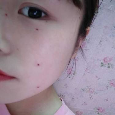 激光点痣