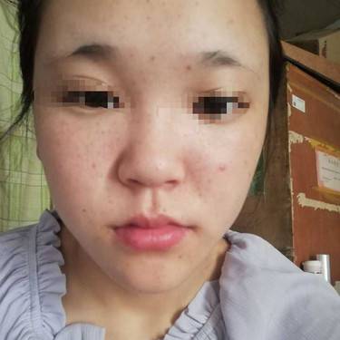 激光淡斑
