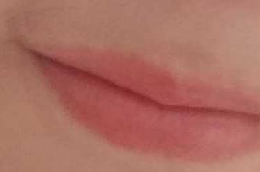 激光点痣