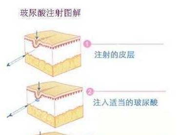 自体脂肪