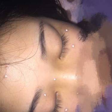 激光点痣