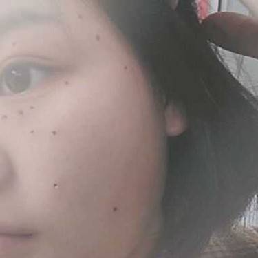 激光点痣
