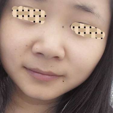 激光点痣