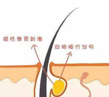 点阵激光