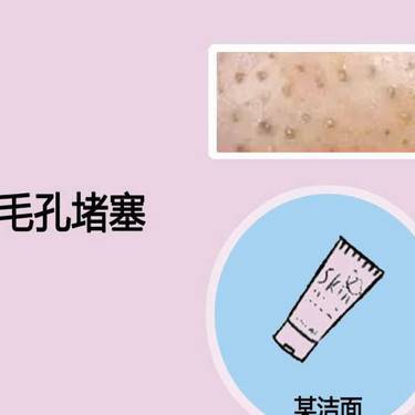 点阵激光