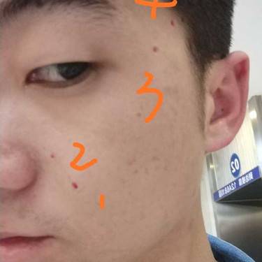 激光点痣