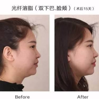 光纤溶脂