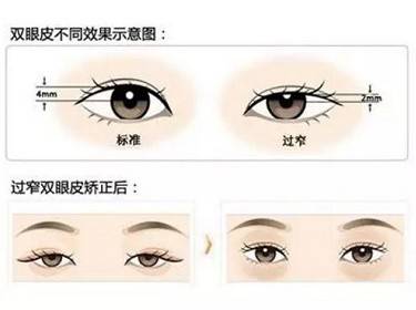 全切双眼皮