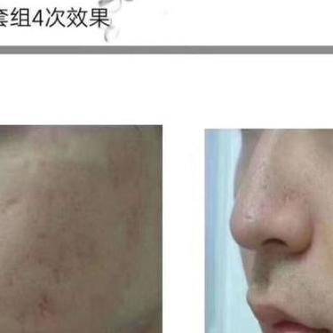伊肤泉微针
