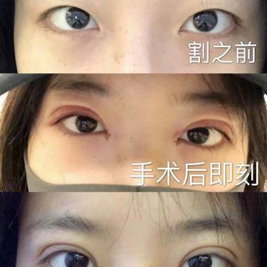 开眼角
