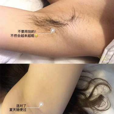 激光脱毛