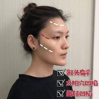 颧骨颧弓整形