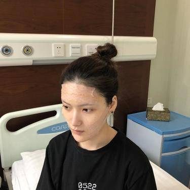 颧骨颧弓整形