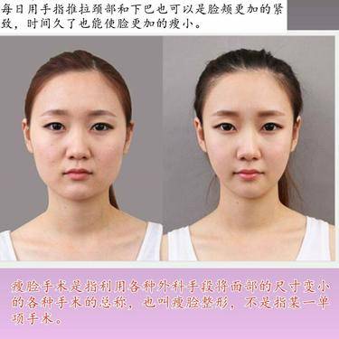 取颊脂垫瘦脸