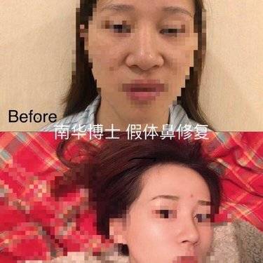 宽鼻矫正