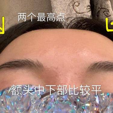 脂肪填充失败修复