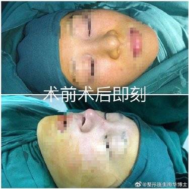 宽鼻矫正