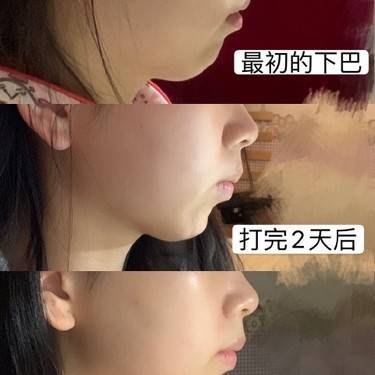 宽下巴矫正