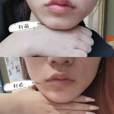 人工骨垫下巴