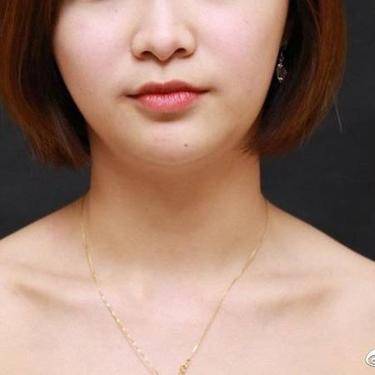 光纤溶脂瘦肩部