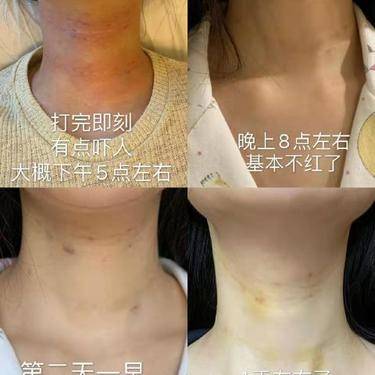 嗨体淡化颈纹