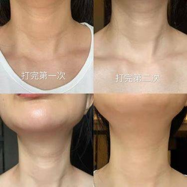 嗨体淡化颈纹
