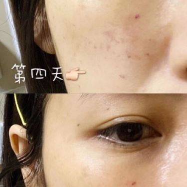 胶原蛋白改善面部细纹