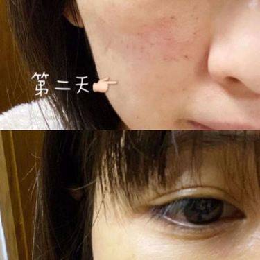 胶原蛋白改善面部细纹