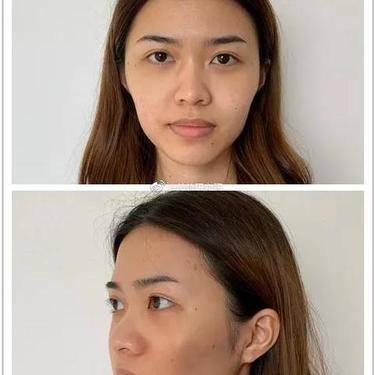 脂肪填充失败修复