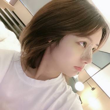 宽鼻矫正