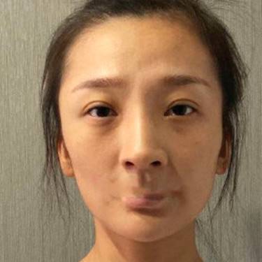 自体脂肪身体塑形