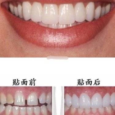 树脂贴面